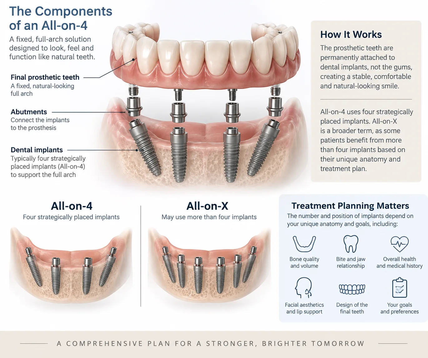 All-on-4 and All-on-X dental implant components and treatment-planning infographic