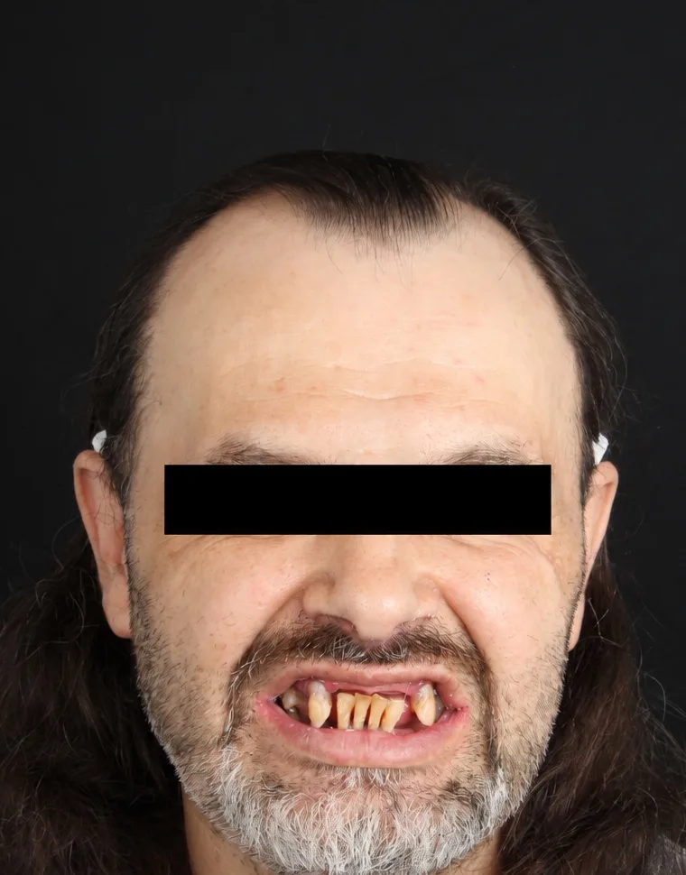 Patient 03 before treatment